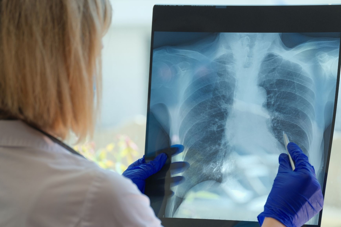 Pljučna hipertenzija pogosto ostaja predolgo nediagnosticirana